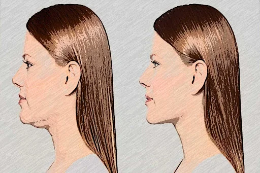 Double Chin Exercises