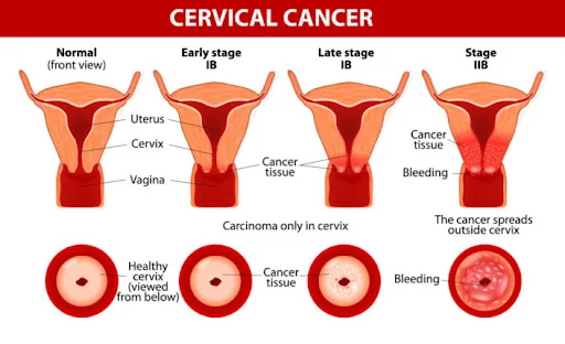 Cervical Cancer Tips