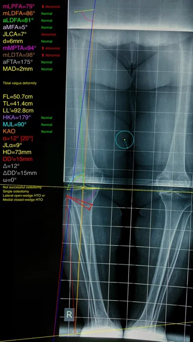 OsteotomyApp